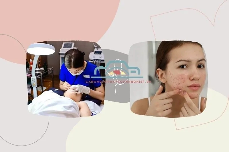 Danh sách các spa trị mụn Bạc Liêu uy tín