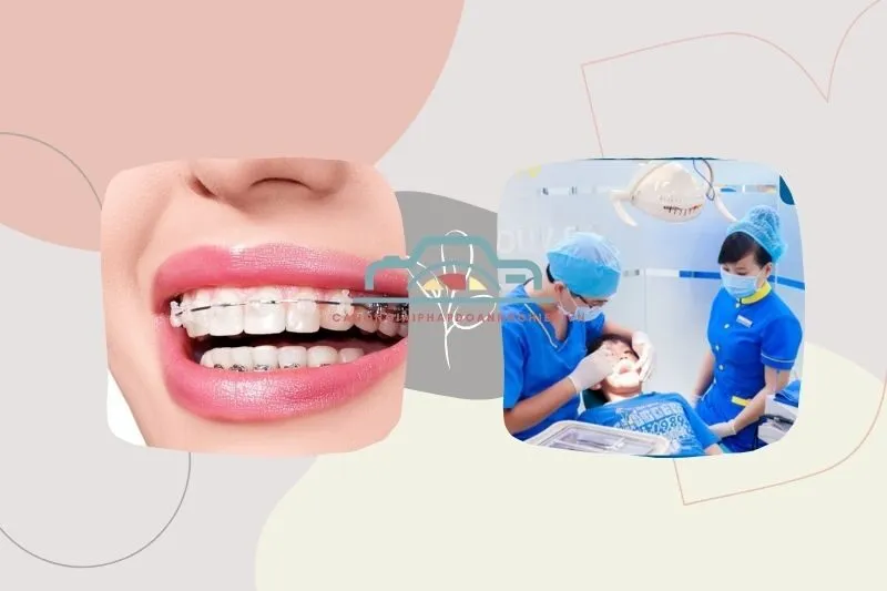 Địa chỉ niềng răng Bạc Liêu uy tín – Top 10 phòng khám chất lượng